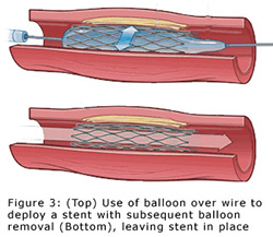 Peripheral Angioplasty Stent